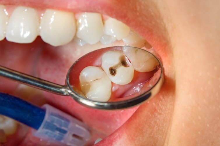 Nhổ răng hàm trên trong cùng bị sâu 