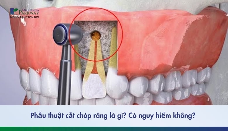 cắt chóp răng - 1