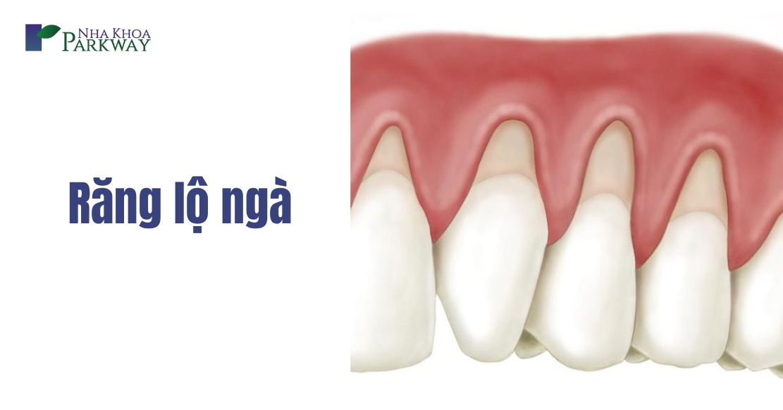 Răng lộ ngà là gì? Cách điều trị lộ ngà răng