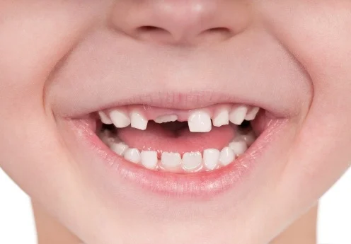 tại sao răng sữa chưa rụng đã mọc răng mới