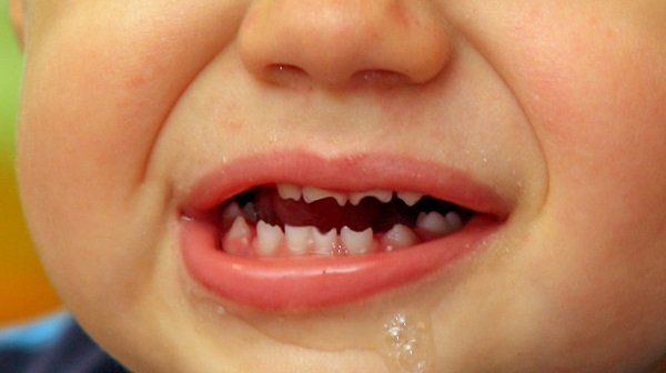 thiểu sản răng ở trẻ 