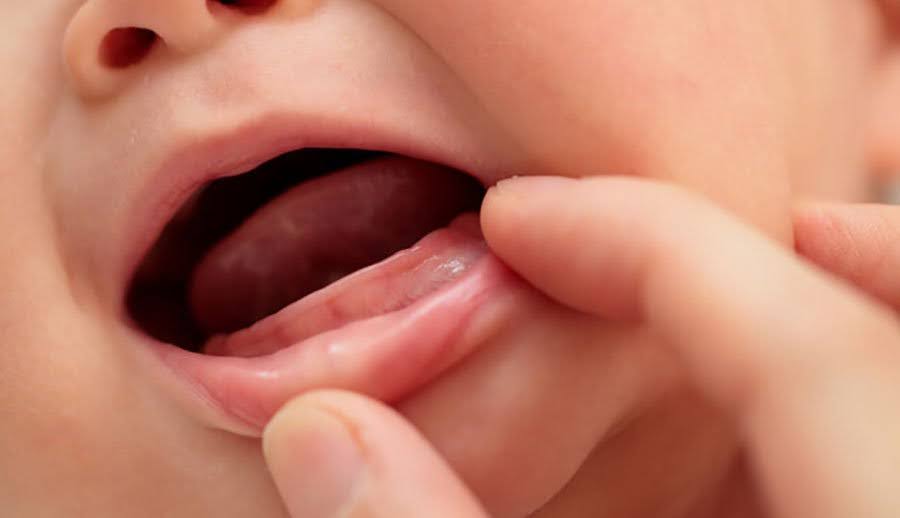 Trẻ mọc răng nanh trước răng cửa