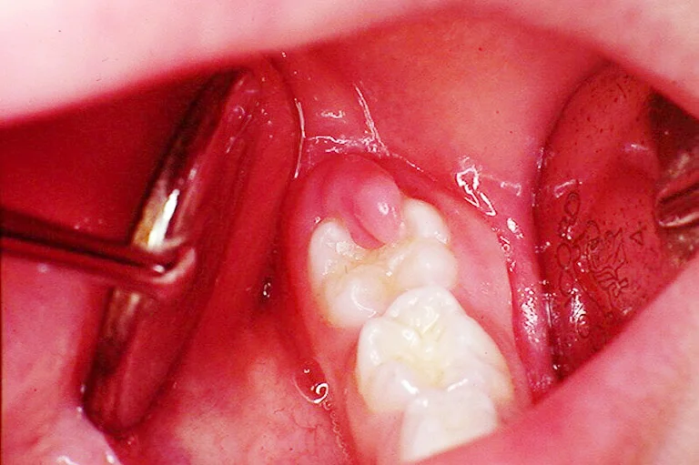 viêm lợi trùm răng khôn khi mang thai