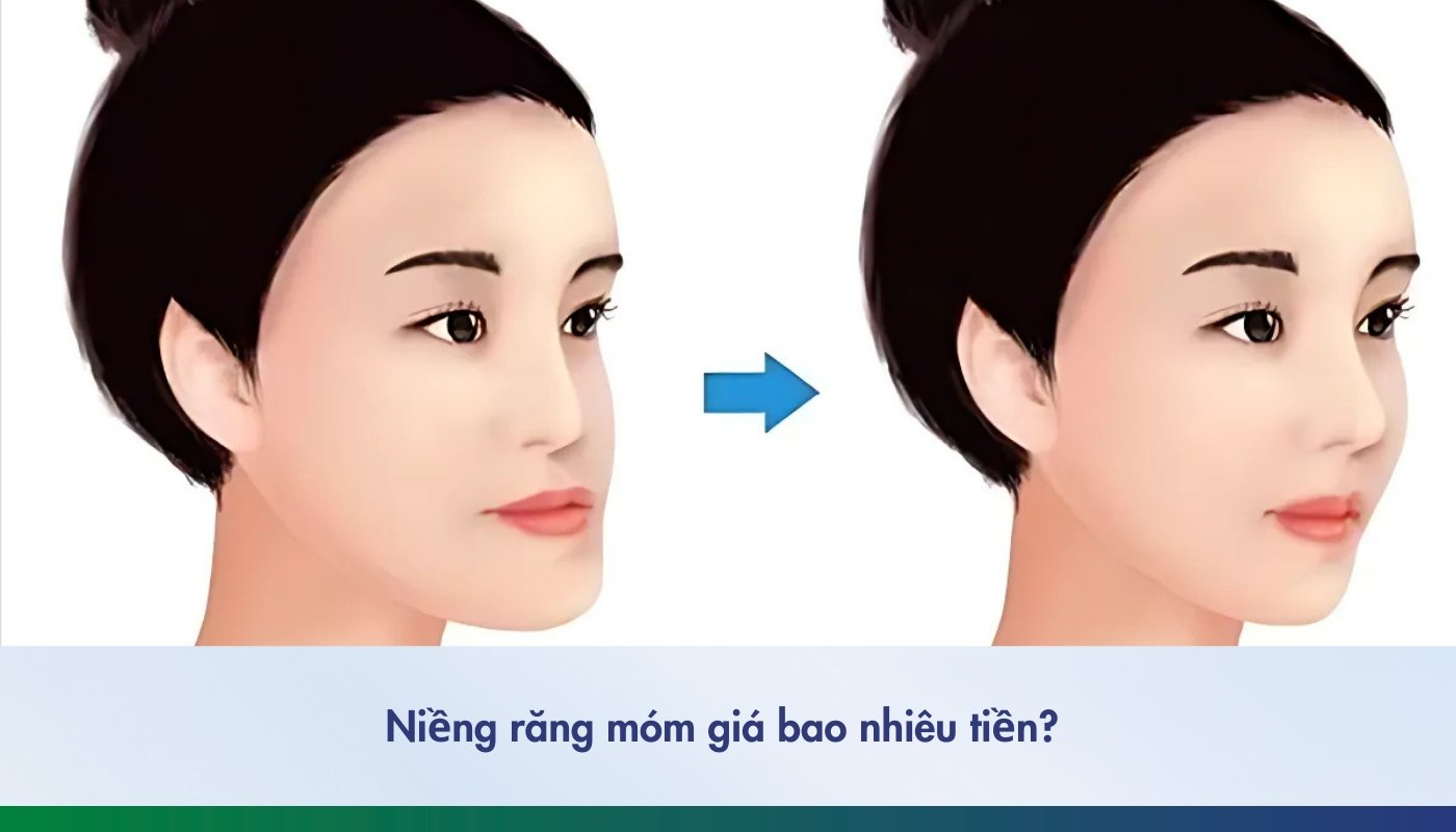 Niềng răng móm giá bao nhiêu tiền và thời gian bao lâu