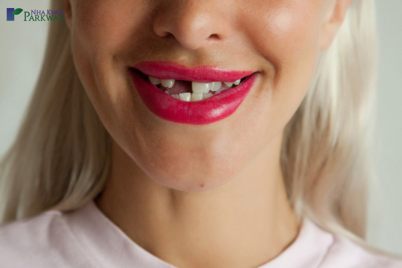ai nên trồng răng implant nha khoa