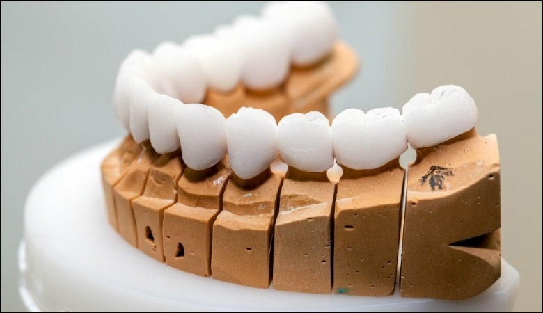 Răng sứ là một loại răng giả được chế tạo từ chất liệu sứ nha khoa