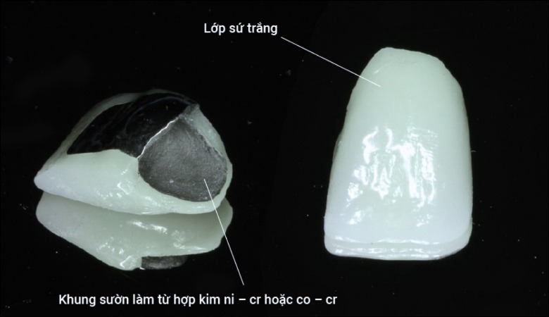 Răng sứ kim loại là một loại răng giả được sử dụng phổ biến trong nha khoa