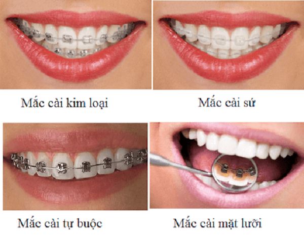 các phương pháp niềng răng