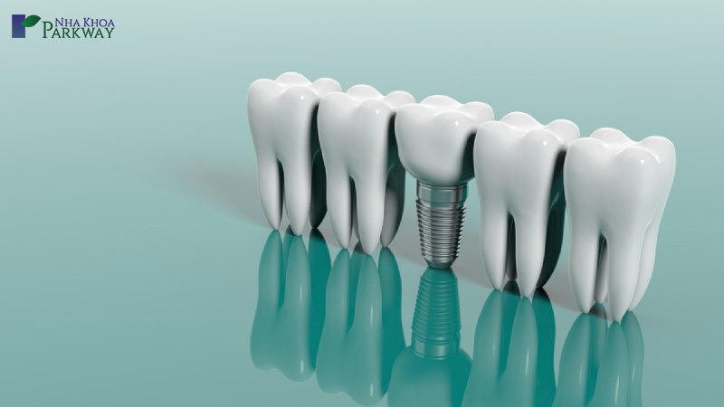 làm implant là xu hướng hiện tại