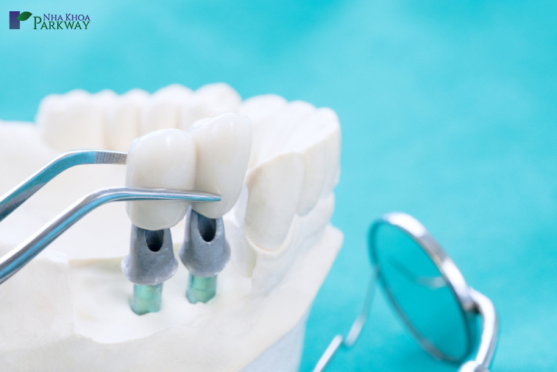nhược điểm của trồng răng implant