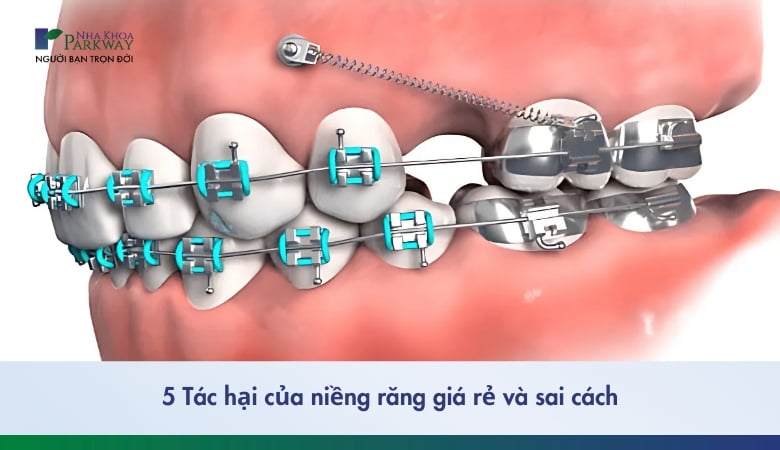 5 tác hại của việc niềng răng giá rẻ bạn cần biết