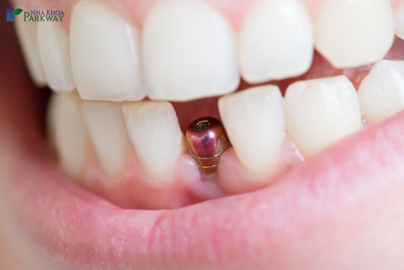 trồng implant để có nụ cười tươi