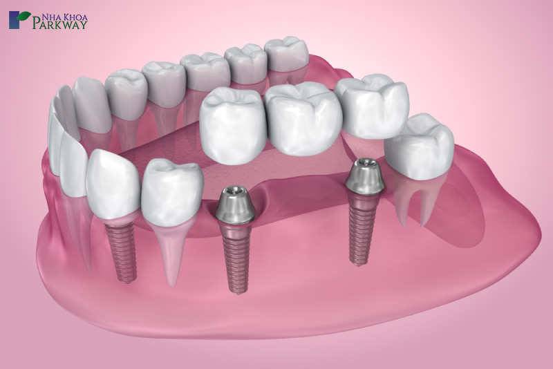 trồng răng cầu răng trên implant