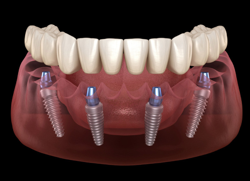 trồng răng implant all-on-4