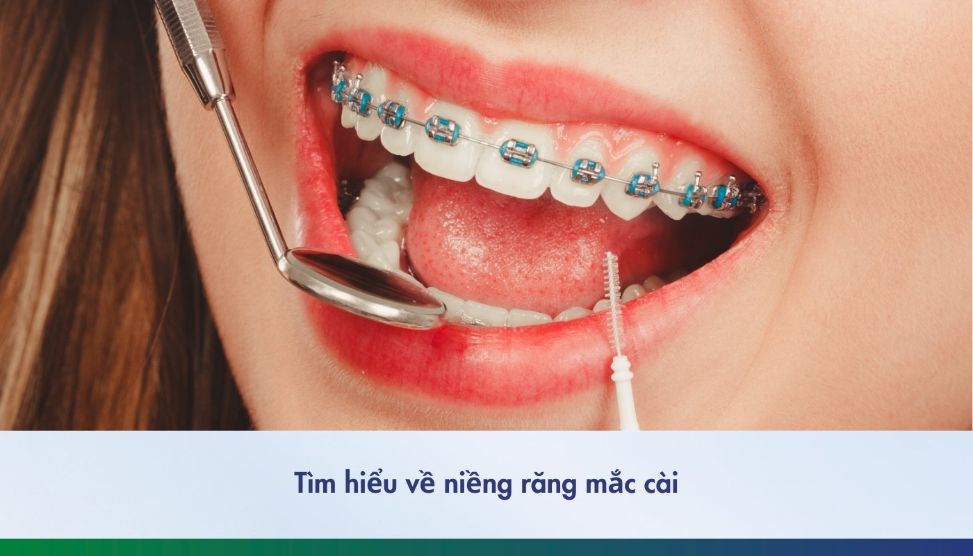 Niềng răng mắc cài: Phân loại, công dụng và giá thành