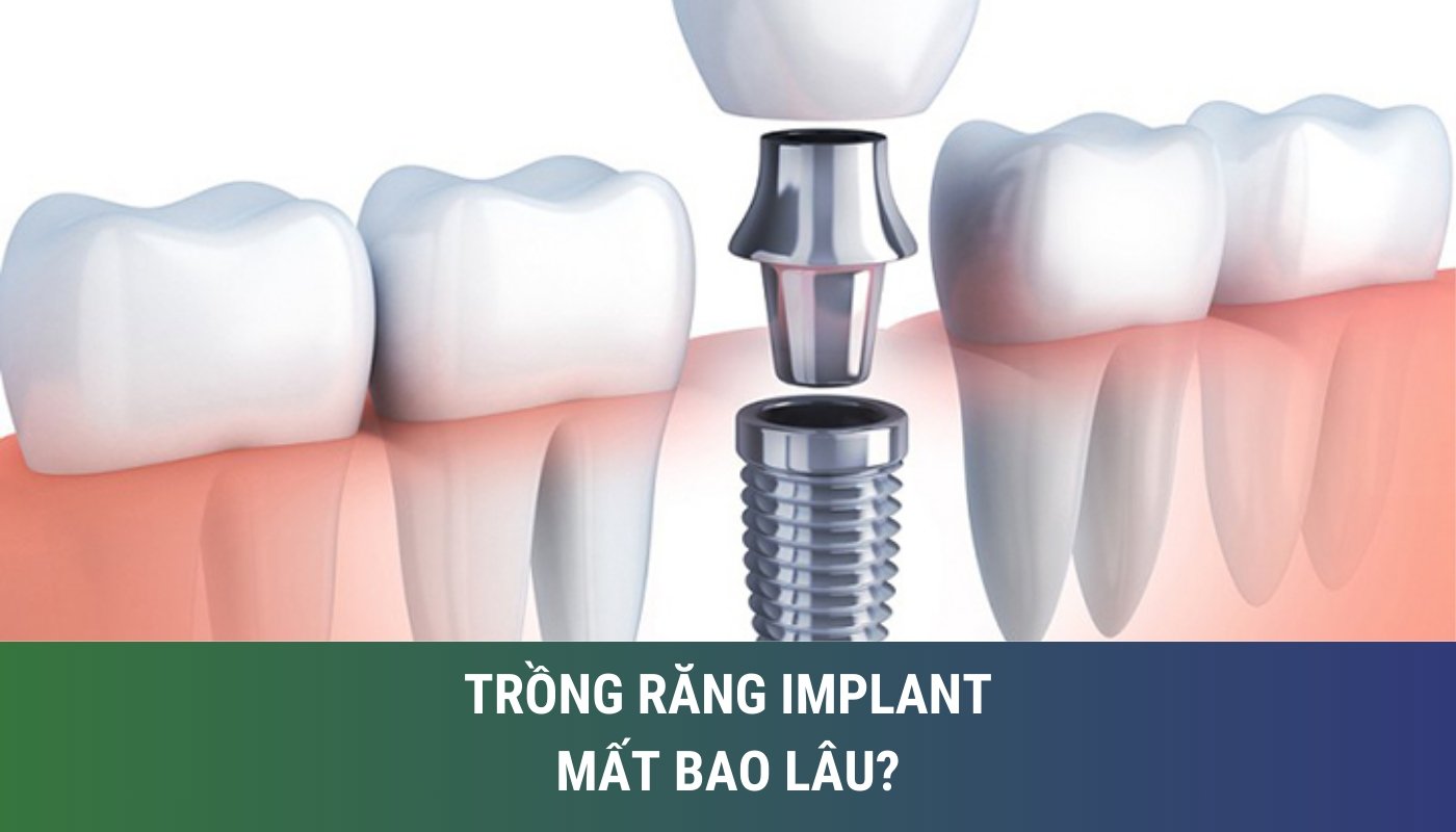 Trồng răng implant mất bao lâu