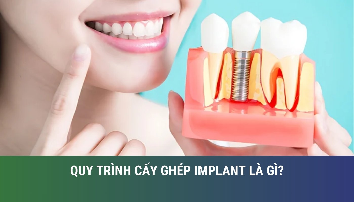 Cấy ghép implant là gì?