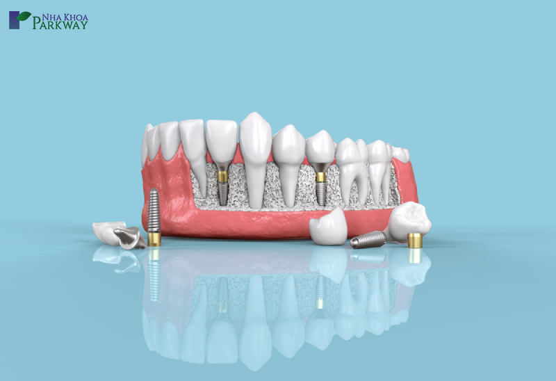 cấy ghép răng implant ở đâu uy tín ở tphcm