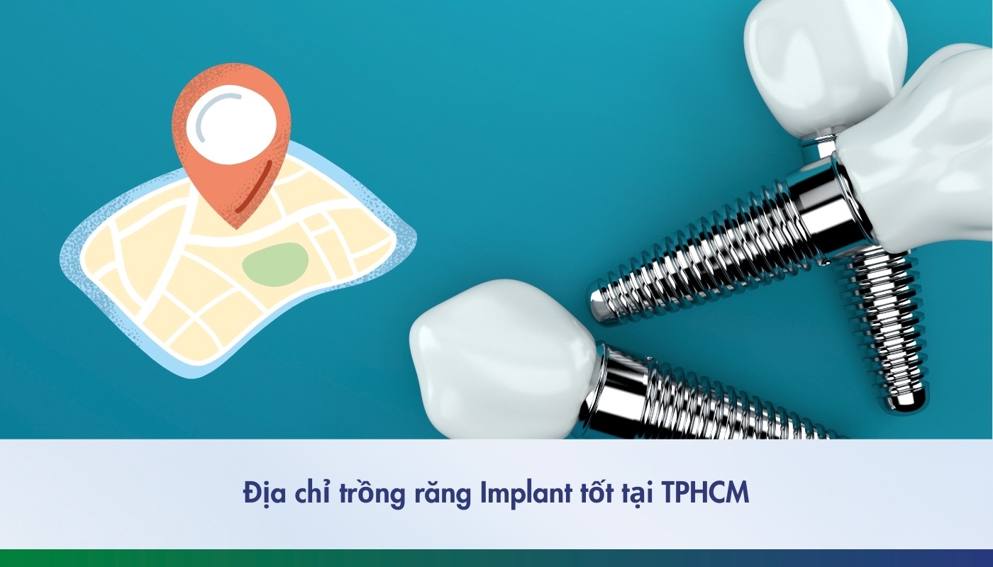 9 địa chỉ trồng răng implant tốt tại Thành phố Hồ Chí Minh