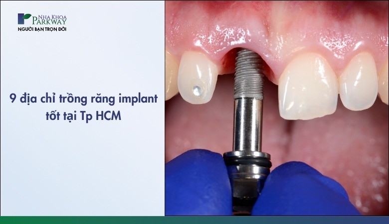 9 địa chỉ trồng răng implant tốt tại thành phố Hồ Chí Minh