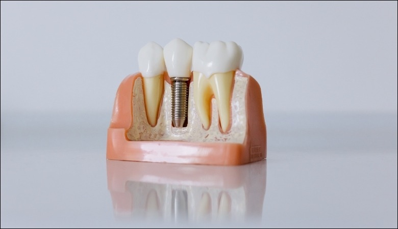 Trồng răng implant là phương pháp phục hình răng mất hiện đại