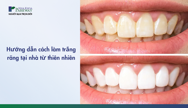 làm trắng răng ngay tại nhà