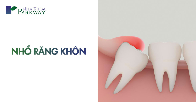 lưu ý trước sau khi nhổ răng khôn là gì