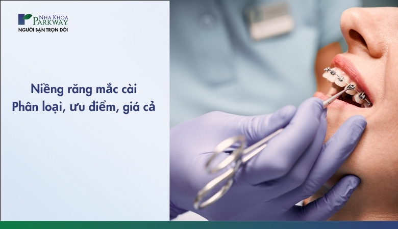 Niềng răng mắc cài - 1