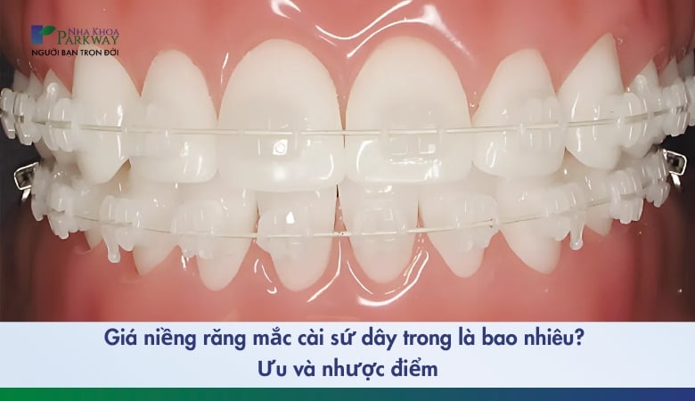 Niềng răng mắc cài sứ dây trong