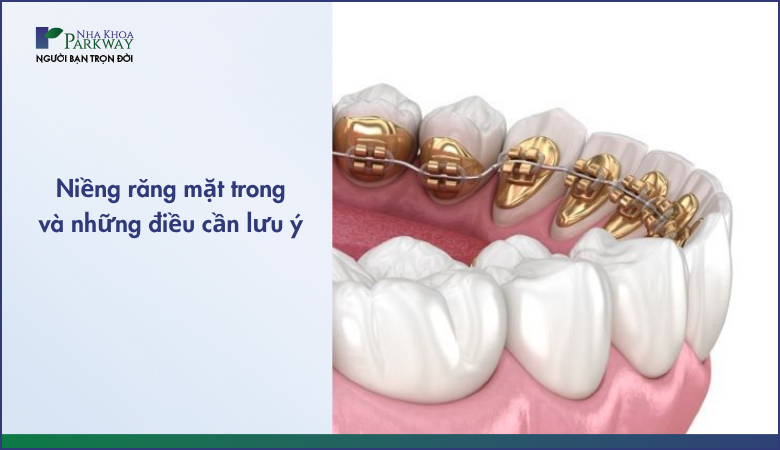 Niềng răng mặt trong và những điều cần lưu ý