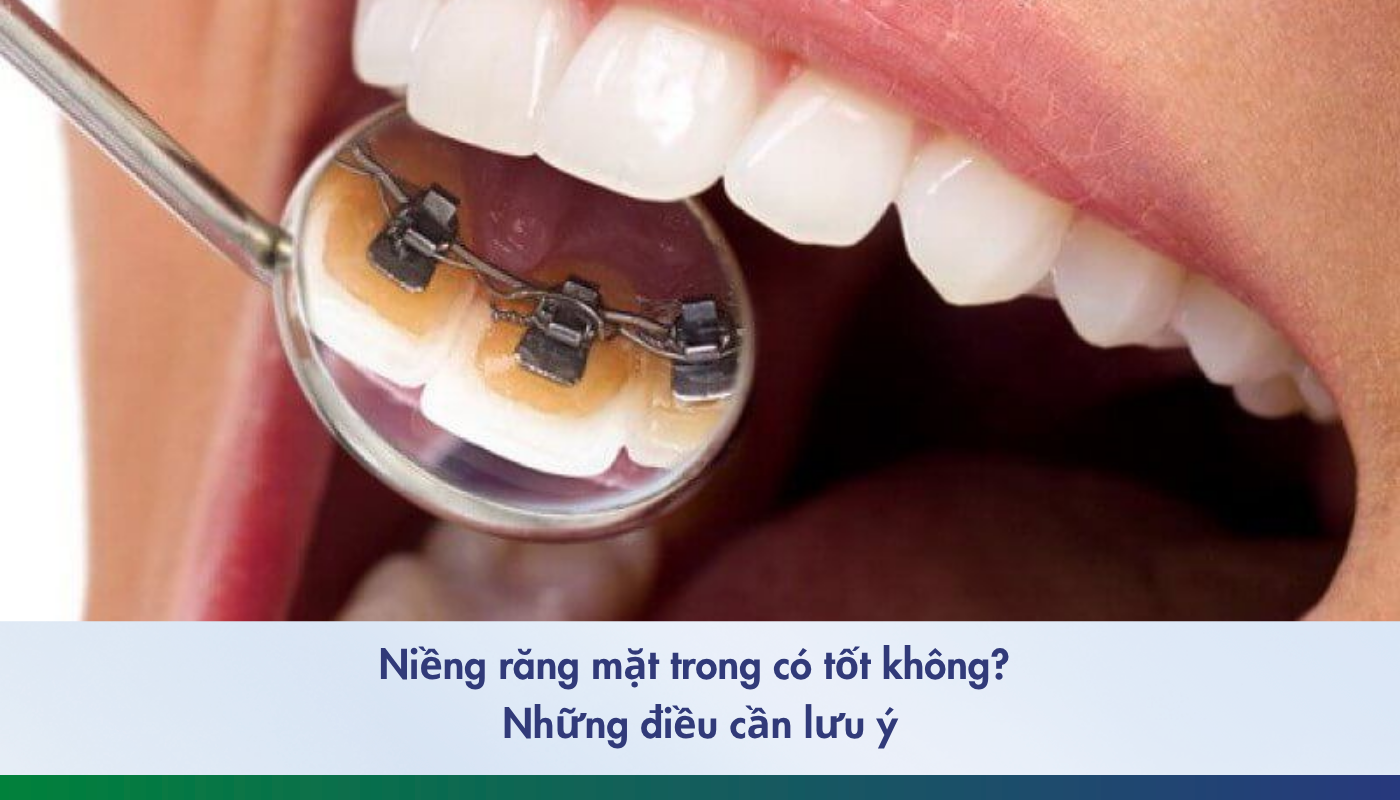 Niềng răng mặt trong