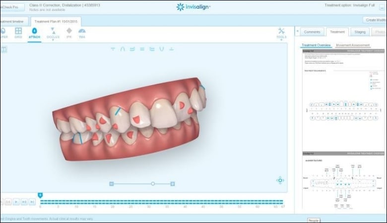 Quy trình niềng răng Invisalign - 2