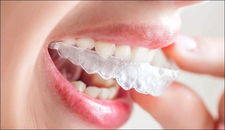 Đeo khay niềng răng trong suốt Invisalign đủ thời gian 