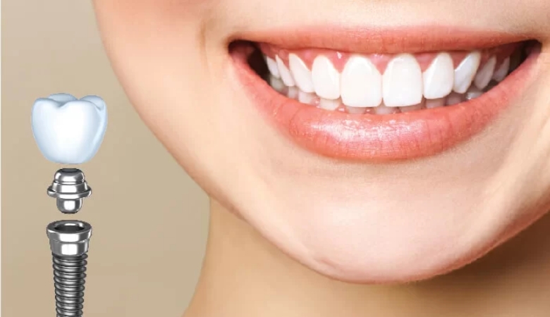 Hình ảnh cô gái cười tươi cùng trụ răng implant