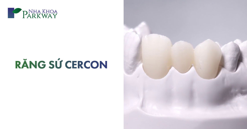 bọc răng sứ cercon là gì