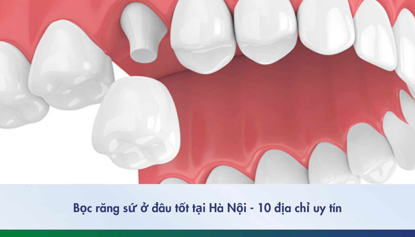 bọc răng sứ ở đâu tốt tại Hà Nội