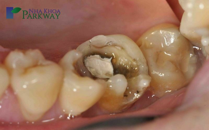 Nguyên nhân răng khôn bị sâu là gì?