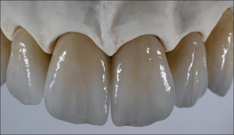 Răng sứ Zirconia lớp