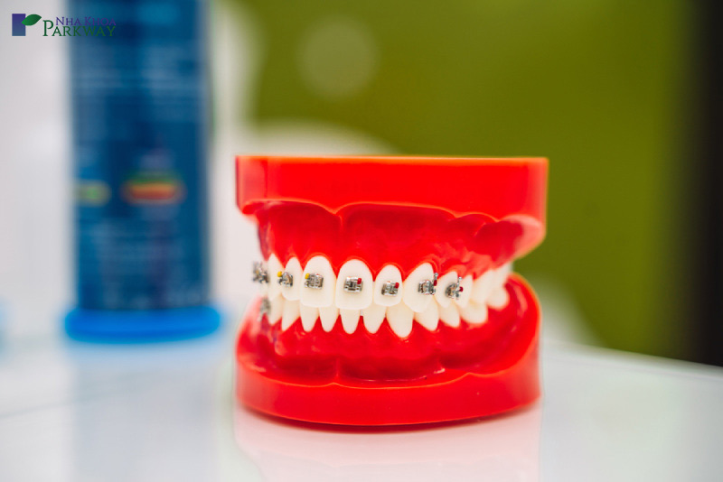 ưu nhược điểm của quy trình bọc răng sứ titanium như thế nào