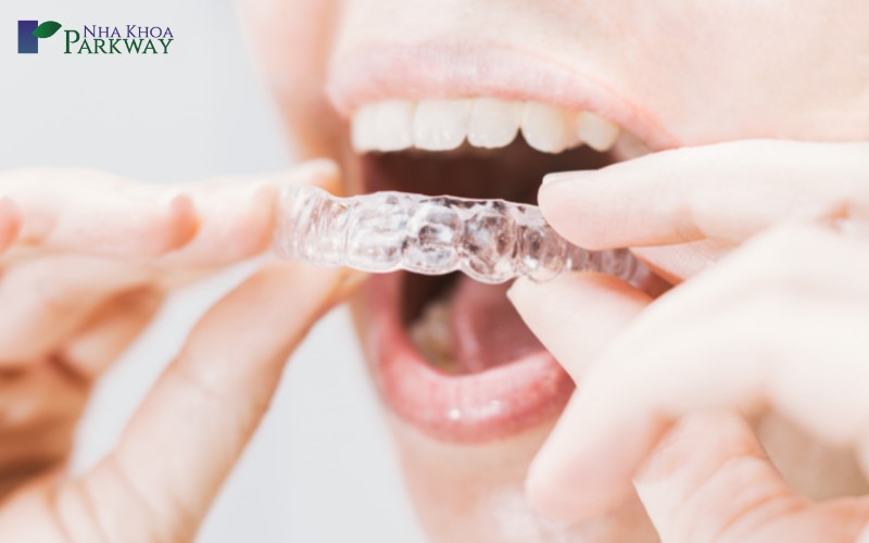 quy trình niềng răng bằng nhựa