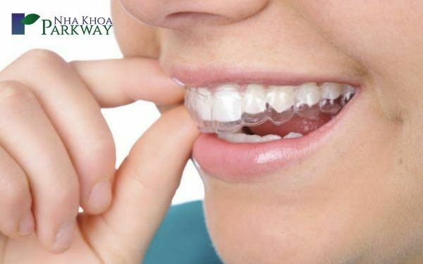 độ tuổi thích hợp niềng răng cho trẻ