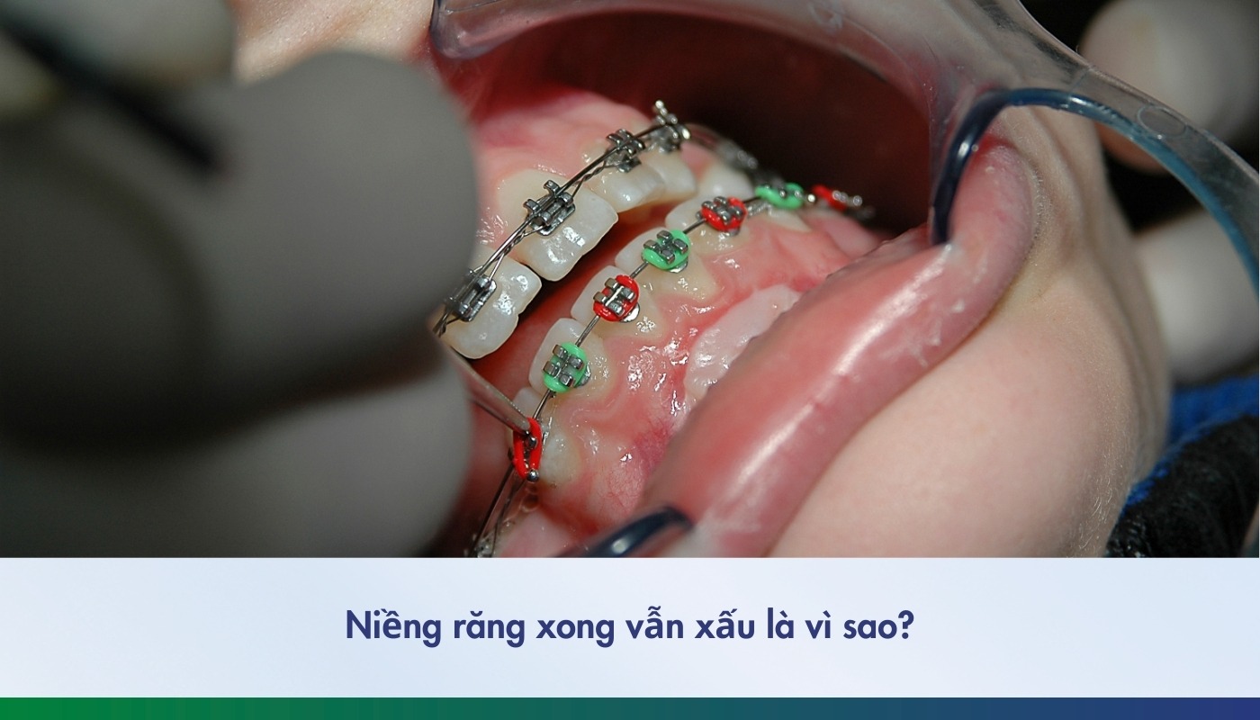 Cách khắc phục niềng răng xong vẫn xấu