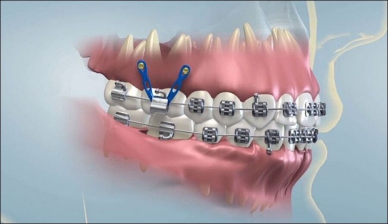 Khí cụ không đạt chuẩn khiến niềng răng xong vẫn xấu