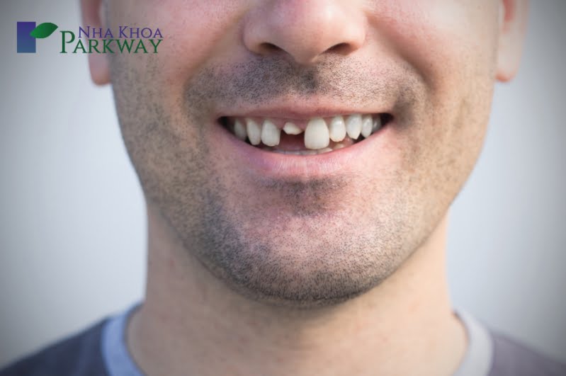 Những trường hợp dẫn đến mất răng cửa thường gặp