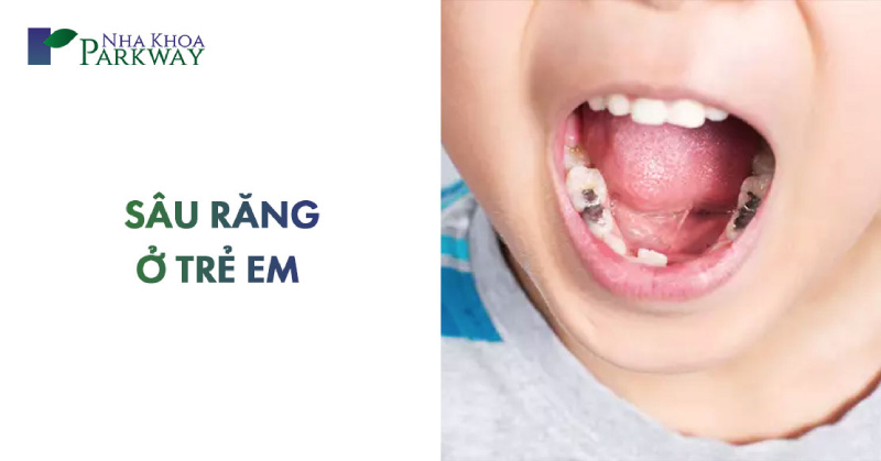 bệnh sâu răng ở trẻ em là gì