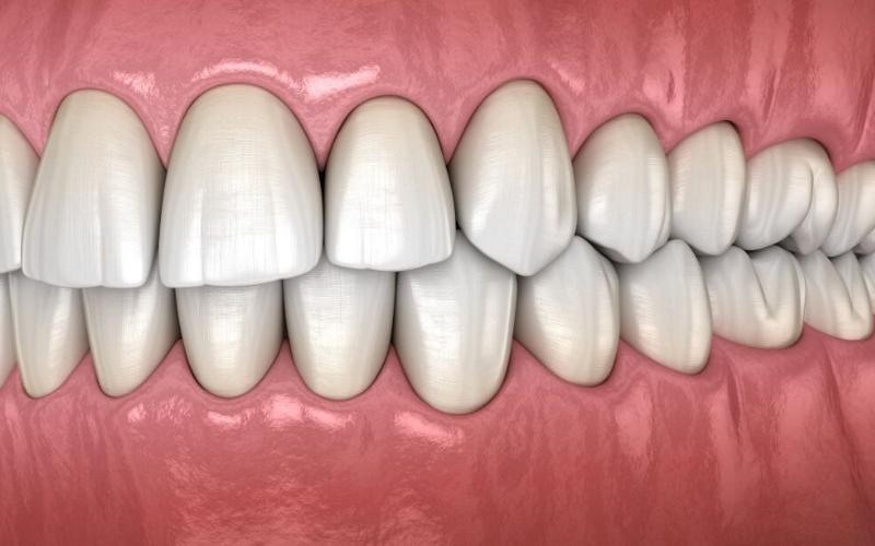 hàm răng chuẩn khớp cắn là gì
