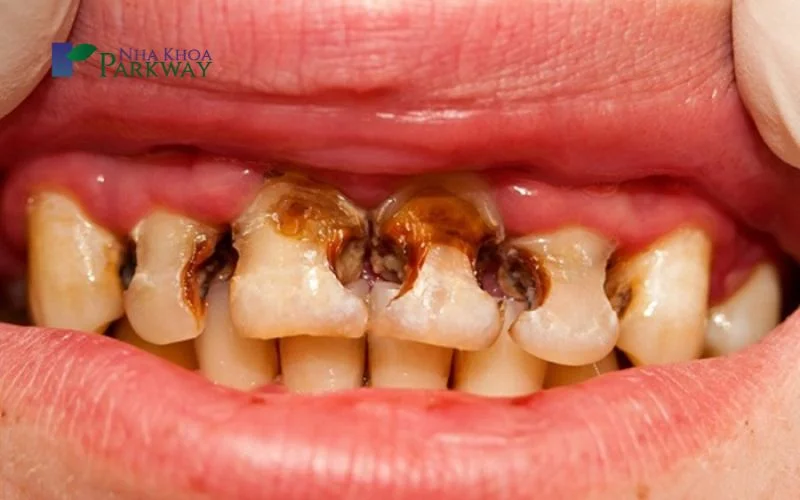 Nguyên nhân dẫn đến sâu răng ở trẻ em