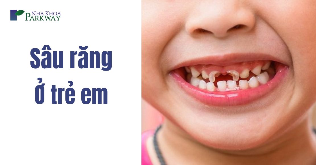 Sâu răng trẻ em và cách điều trị sâu răng ở trẻ em