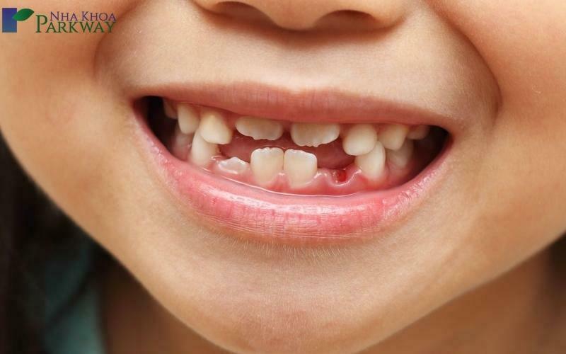 Thứ tự mọc không đúng gây mất thẩm mỹ hàm răng của trẻ