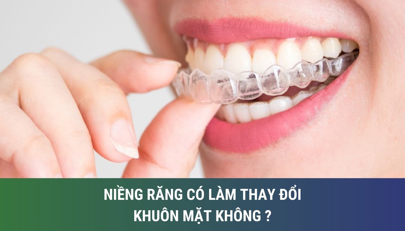 Giải đáp niềng răng có làm thay đổi khuôn mặt nhiều không?